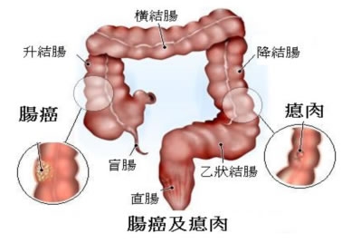 大腸癌  圖/HK腸道檢測中心