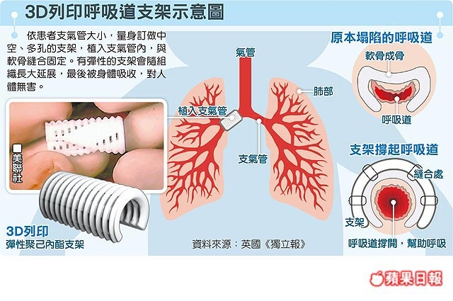 3D列印呼吸道支架過程示意圖