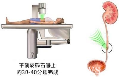 體外震波碎石的原理，患者輕鬆免住院