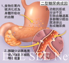 第二型糖尿病成因