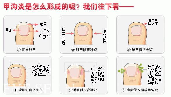 甲溝炎形成原因  圖/醫學網站