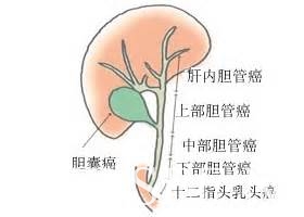 膽道(管)癌的分類 圖/醫學網站截圖