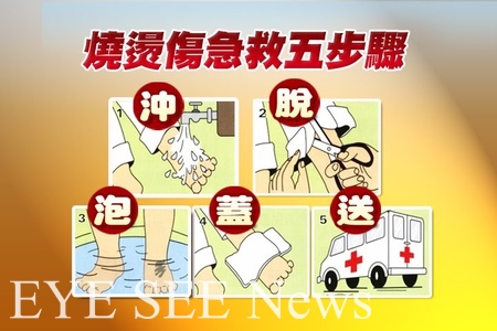 燒燙傷送醫前急救5步驟