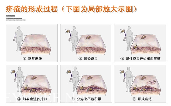 疥瘡形成過程示意圖(圖-中醫醫學網站) 疥瘡形成過程示意圖(圖-中醫醫學網站)