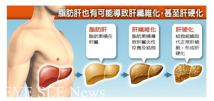 脂肪肝也可能導致肝纖維化,甚至肝硬化 圖/來自董事基金會