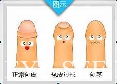 包皮問題面面觀。(圖-泌尿外科醫學網站) 包皮問題面面觀。(圖-泌尿外科醫學網站)