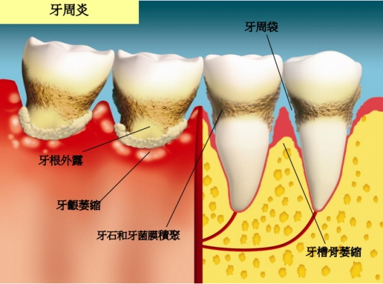 牙周病的成因與過程。圖文／牙醫診所網頁