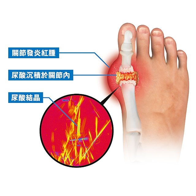 痛風好發位置示意圖。(圖/內科醫學網站)